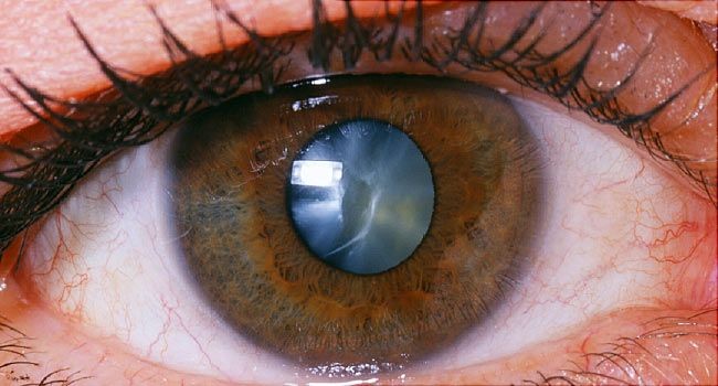 Oftalmologista em Sorocaba especialista em Glaucoma
