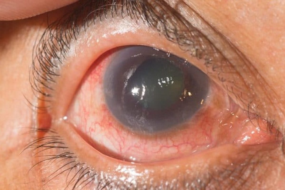 Oftalmologista em Sorocaba especialista em Glaucoma